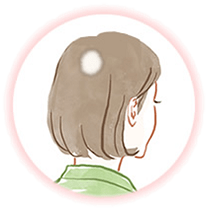 細菌(円形・多発)脱毛症
